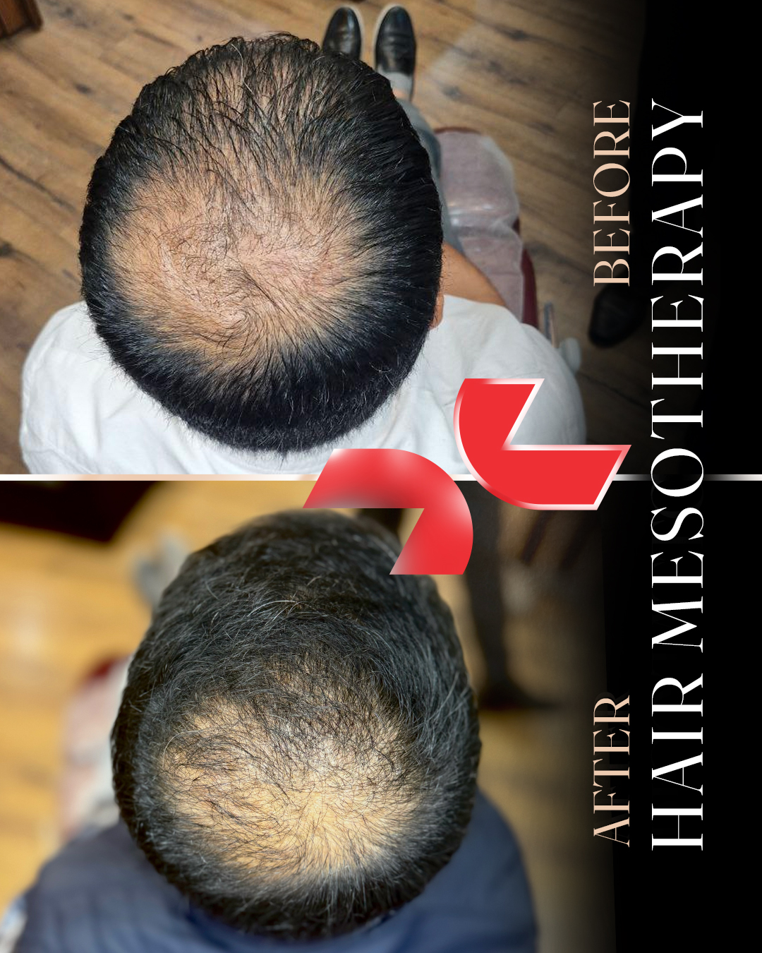 ۶ جلسه لیزر پیکواستار + مزوتراپی رویتاکر