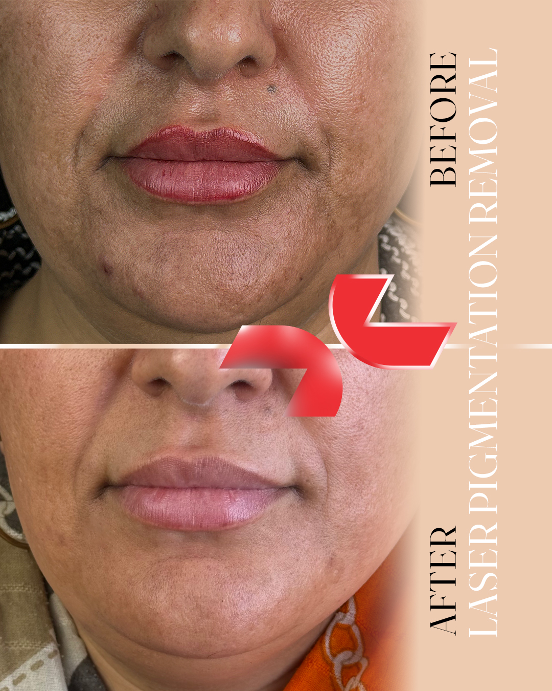 رفع لک صورت