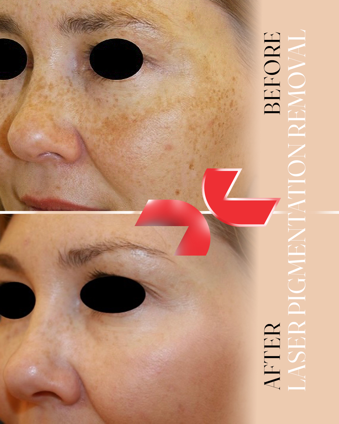 رفع لک صورت