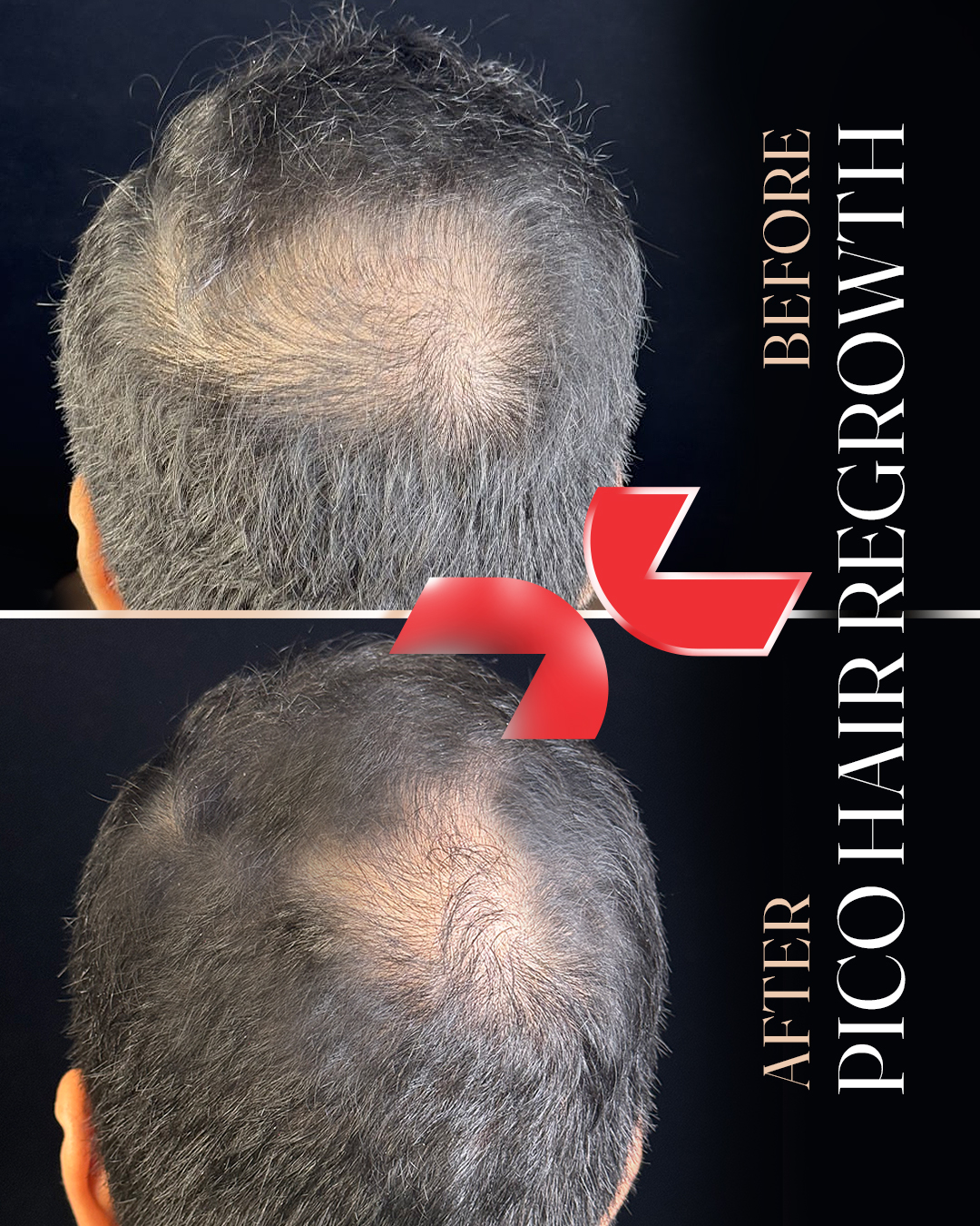 ۶ جلسه لیزر پیکواستار + مزوتراپی رویتاکر