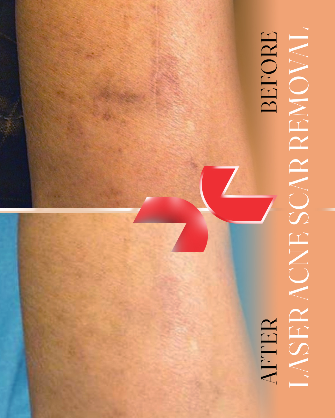 لیزر جای جوش