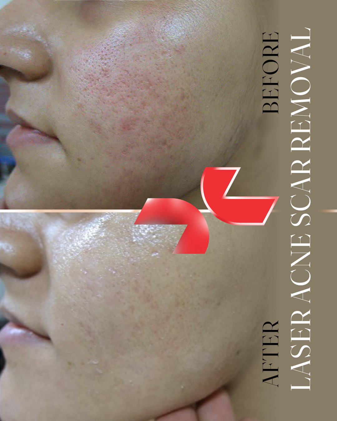 لیزر جای جوش