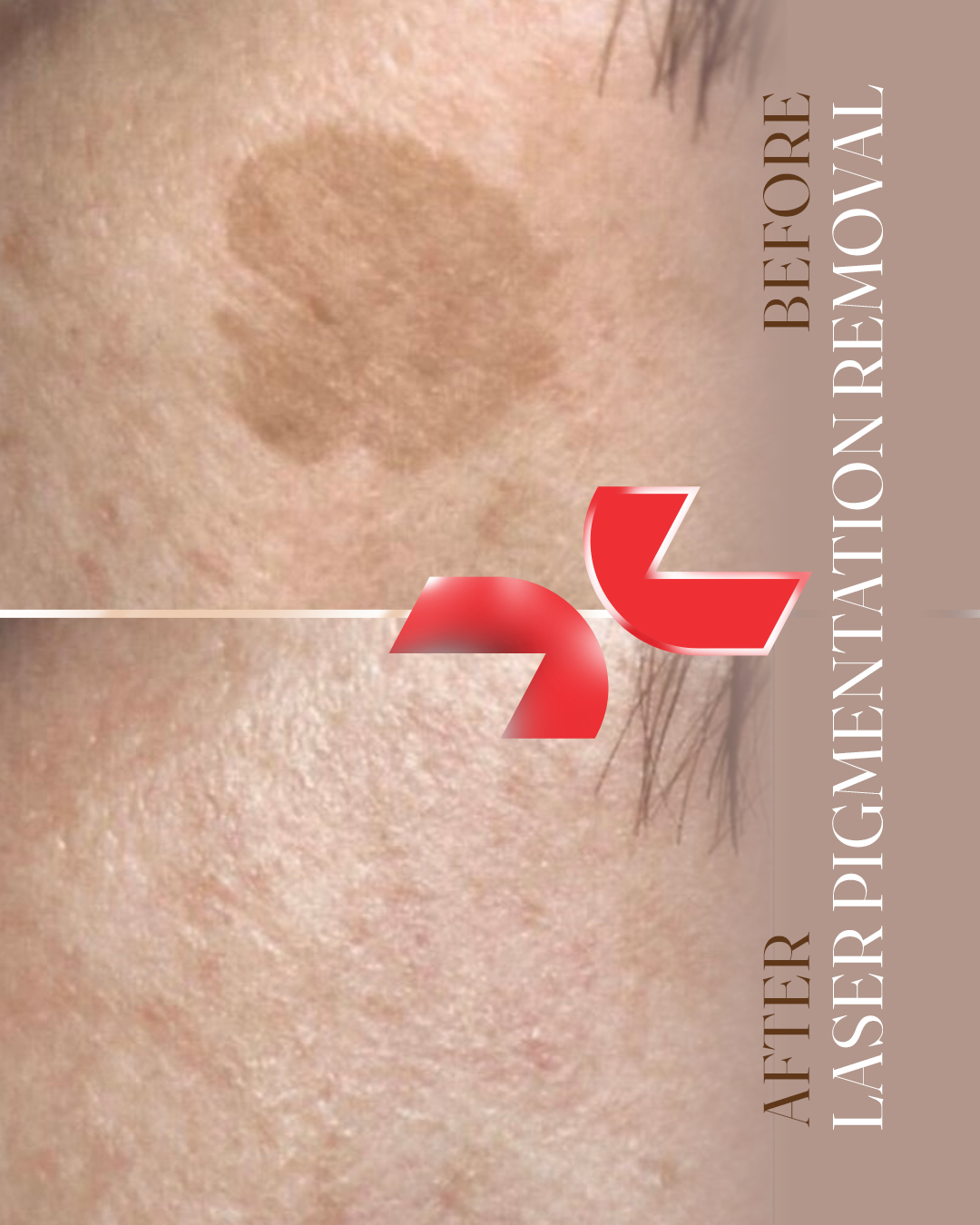 رفع ماه گرفتگی