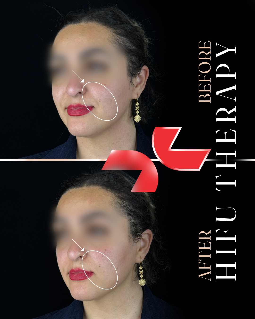 رفع خط خنده + لیفت صورت