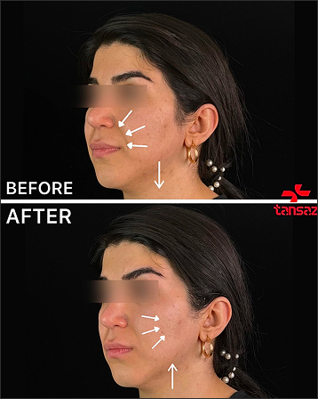 رفع خط خنده + لیفت صورت + رفع خط غم