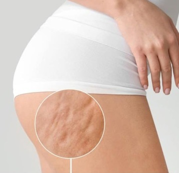 سلولیت چیست و بهترین روش درمان آن کدام است؟