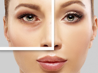 بلفاروپلاستی